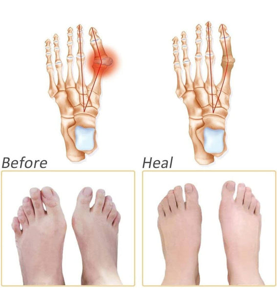 6057 Silicone Gel Half Toe Sleeve Pads (1Pair)